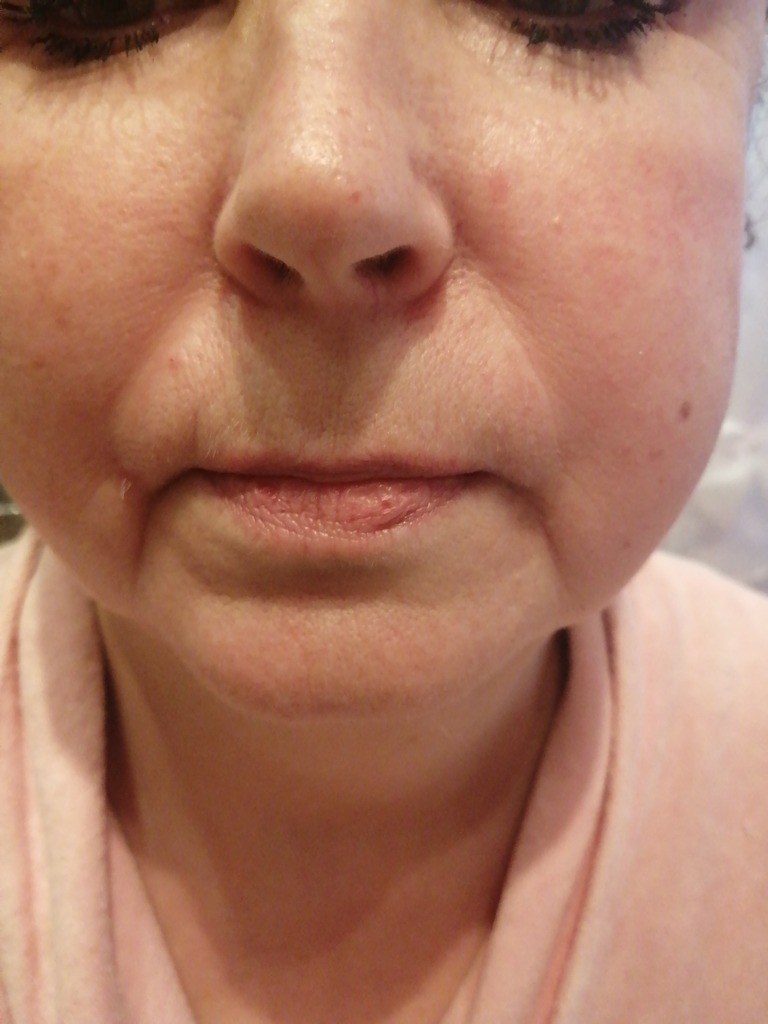 Фото 1. Можно ли вывести Диспорт?