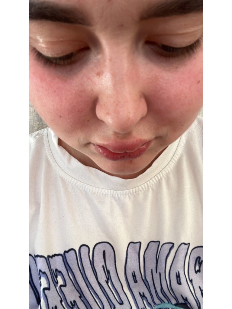 Фото 1. Нужно ли будет удалять филлер? 