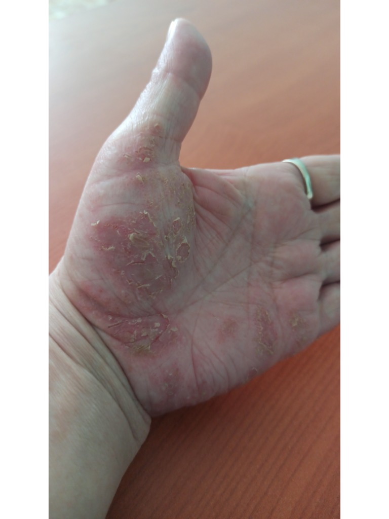 Фото 1. Эфективна ли процедура плазмолифтинга от дерматита?