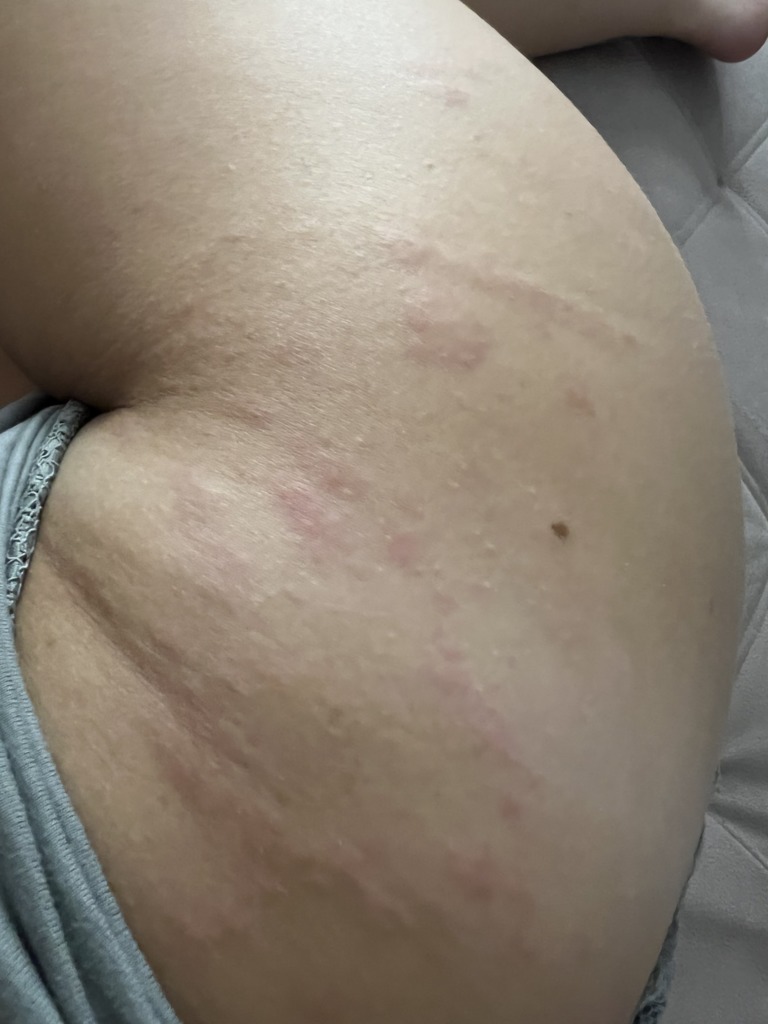 Фото 1. Можно ли делать филлер при крапивнице?