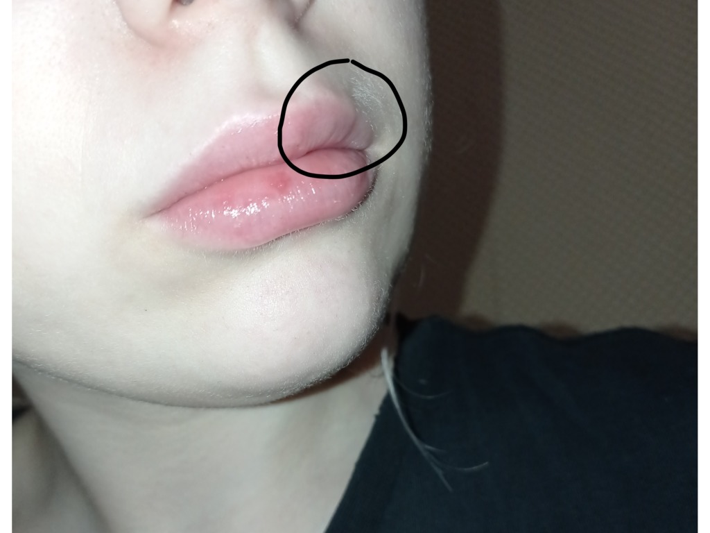 Фото 3. Рассосутся ли выпуклости или нужно удалять филлер из губ?