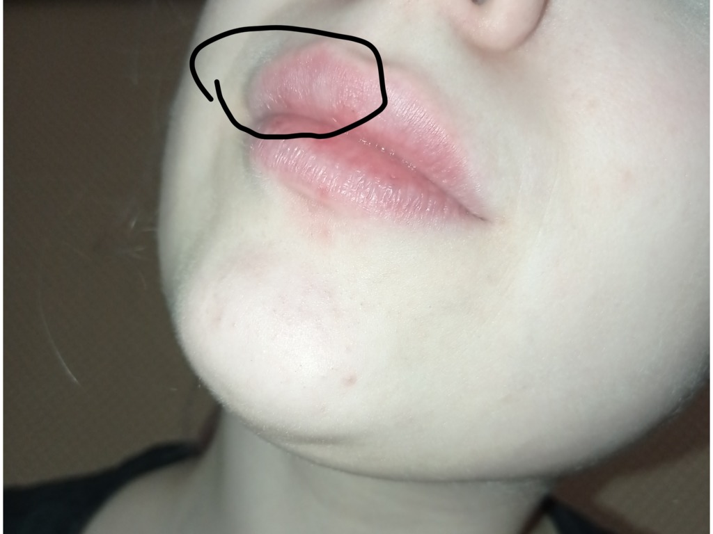 Фото 1. Рассосутся ли выпуклости или нужно удалять филлер из губ?