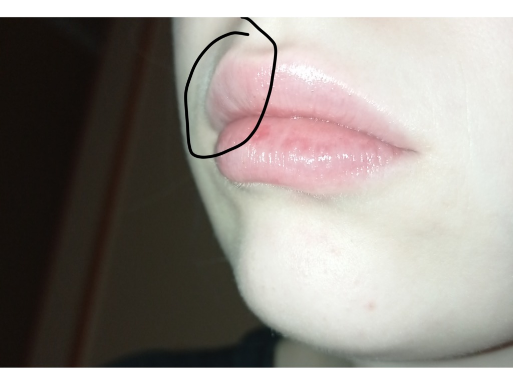 Фото 2. Рассосутся ли выпуклости или нужно удалять филлер из губ?