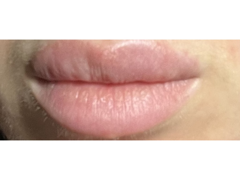Фото 1. Что будет если не убирать фиброз губ и стоит ли выпрямлять губу еще филлером чтобы избежать этот вид гармошки?