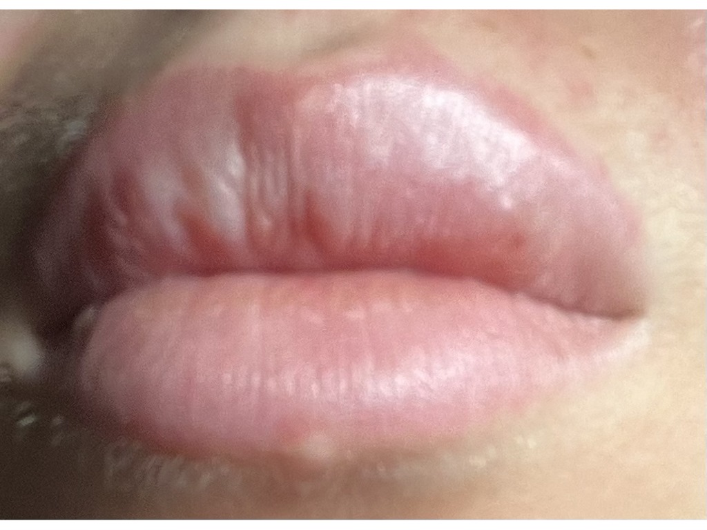 Фото 2. Что будет если не убирать фиброз губ и стоит ли выпрямлять губу еще филлером чтобы избежать этот вид гармошки?