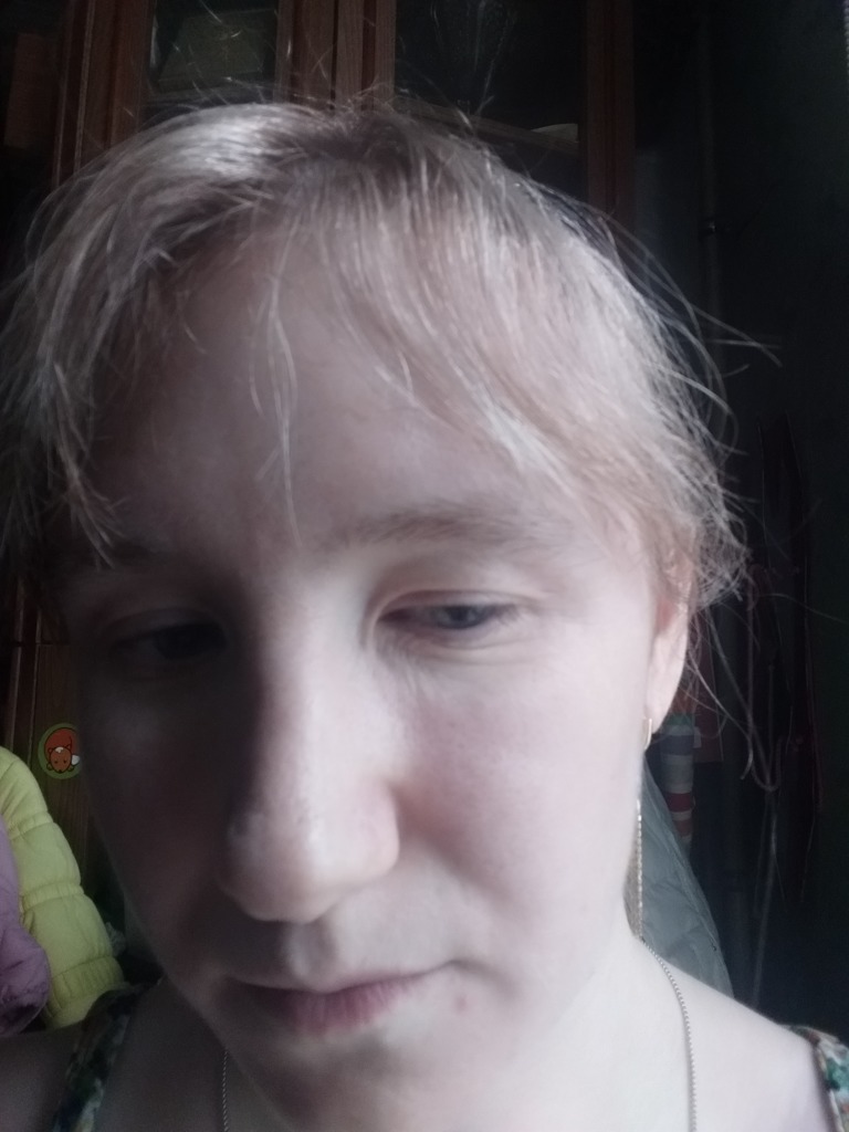 Фото 1. Что лучше СМАС или филлер?