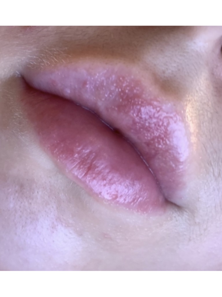 Фото 1. Зуд, жжение и пузырьки на губах