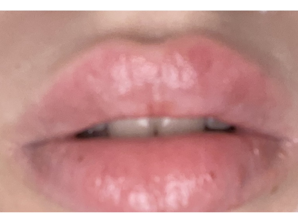 Фото 2. Осложнения после коррекции губ
