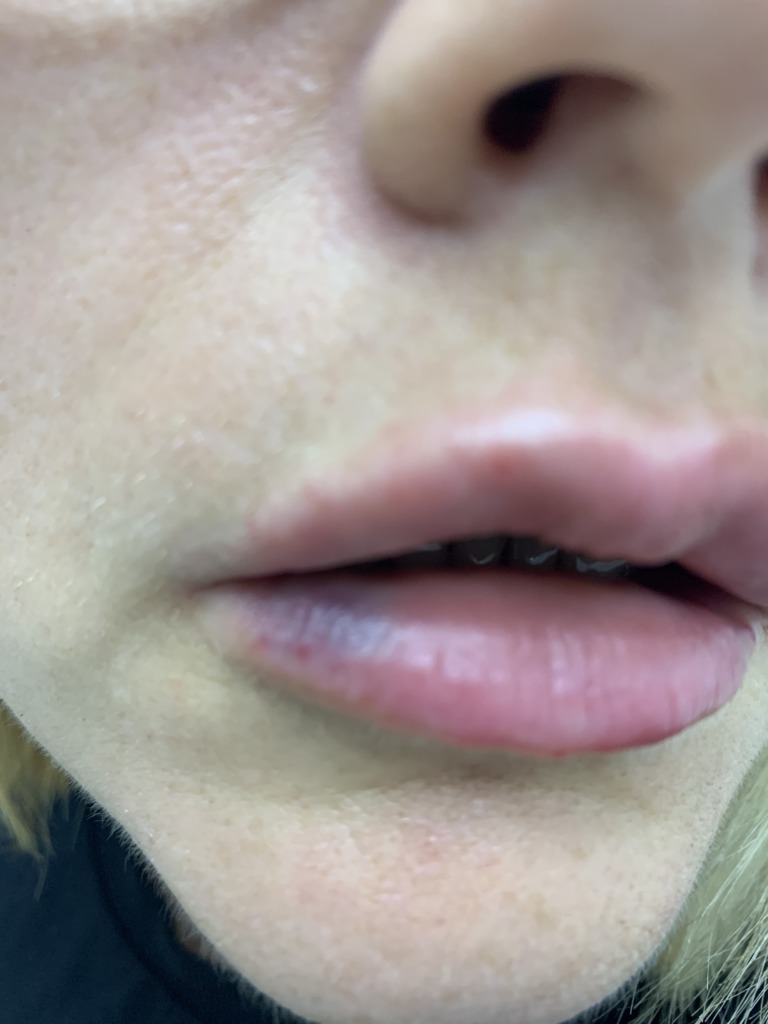 Фото 1. Гематома после контурной пластики губ