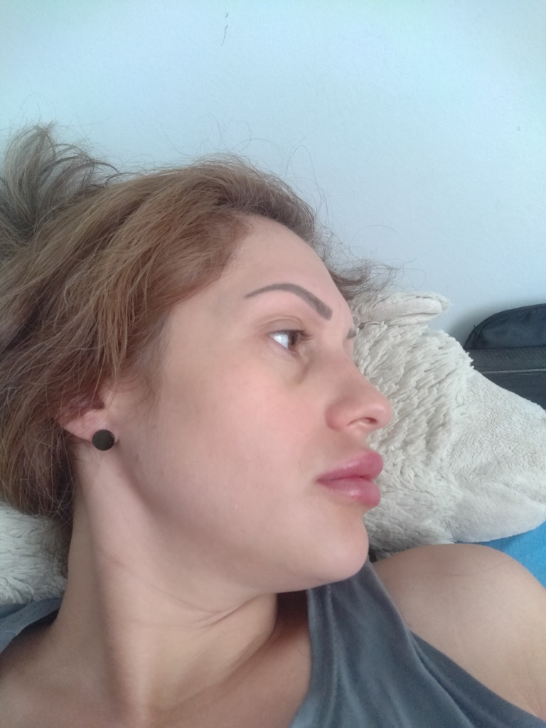 Фото 2. Отек после коррекции губ