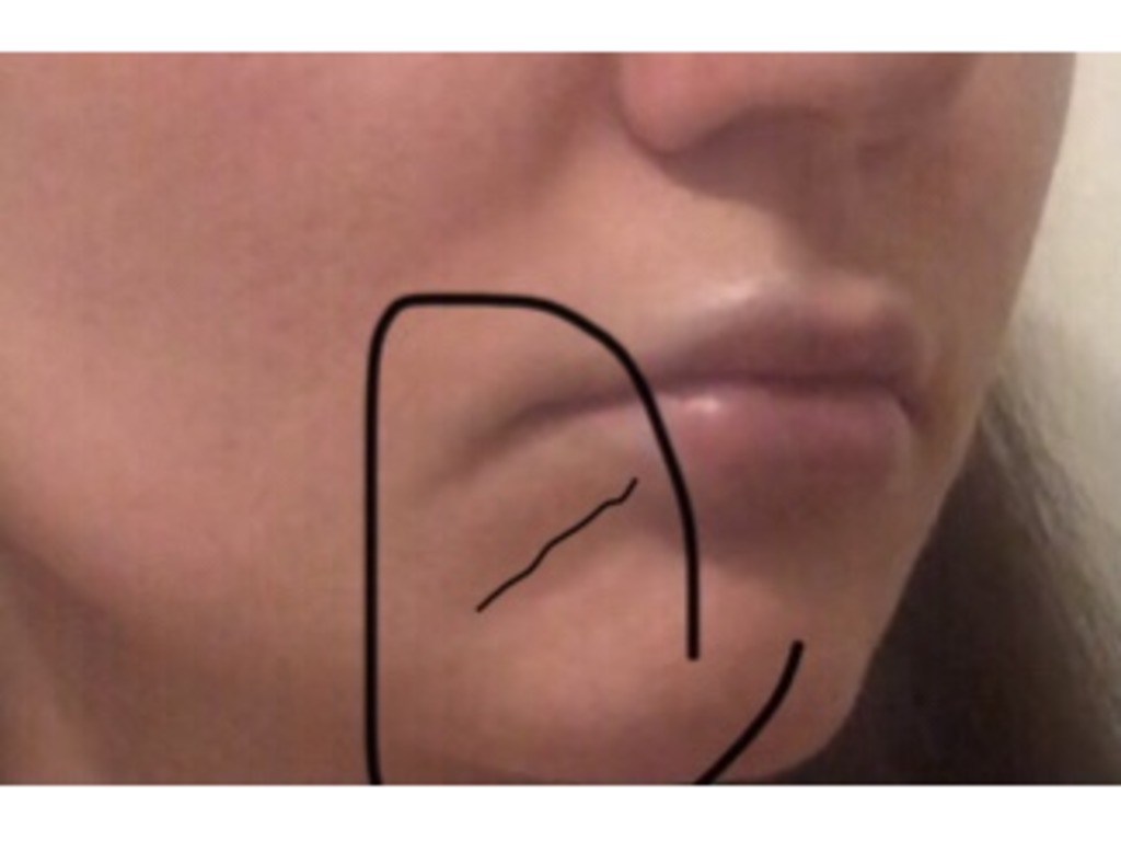 Фото 1. Дефект тканей нижней губы