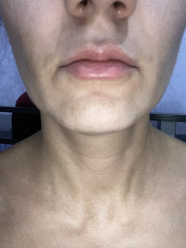 Фото 1. Коррекция носогубных складок