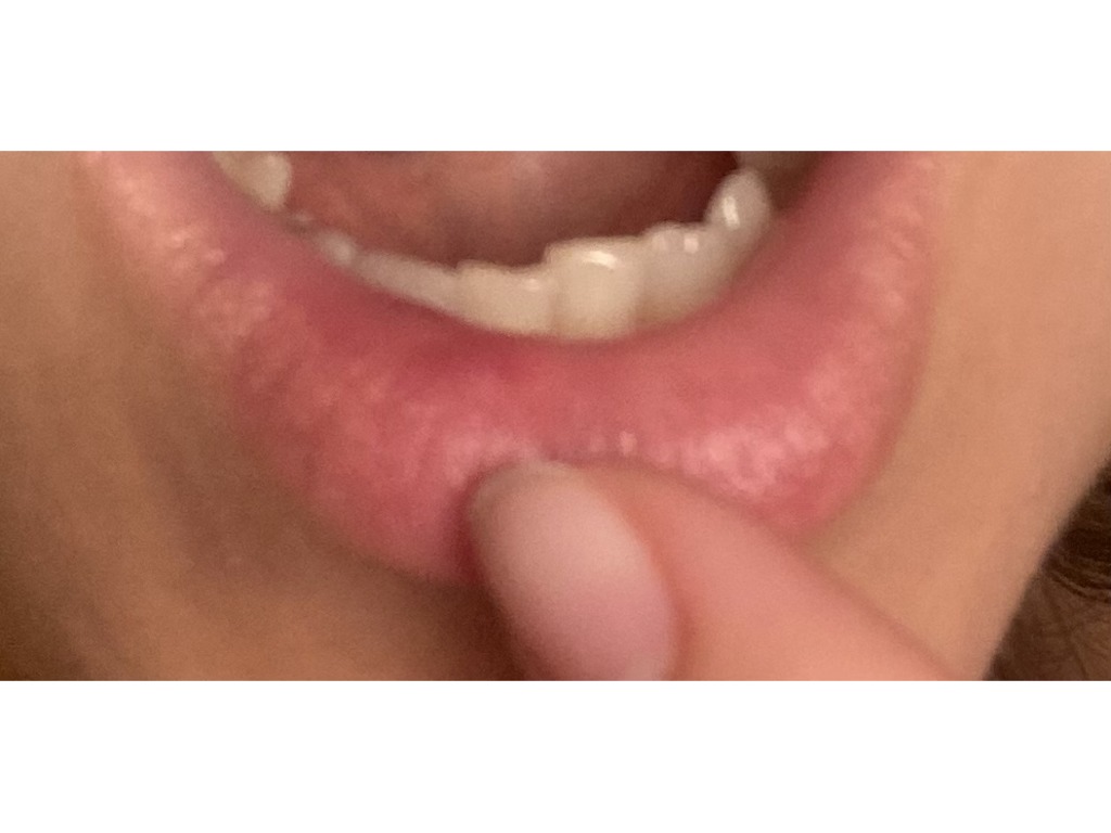 Фото 1. Уплотнение на губе после коррекции
