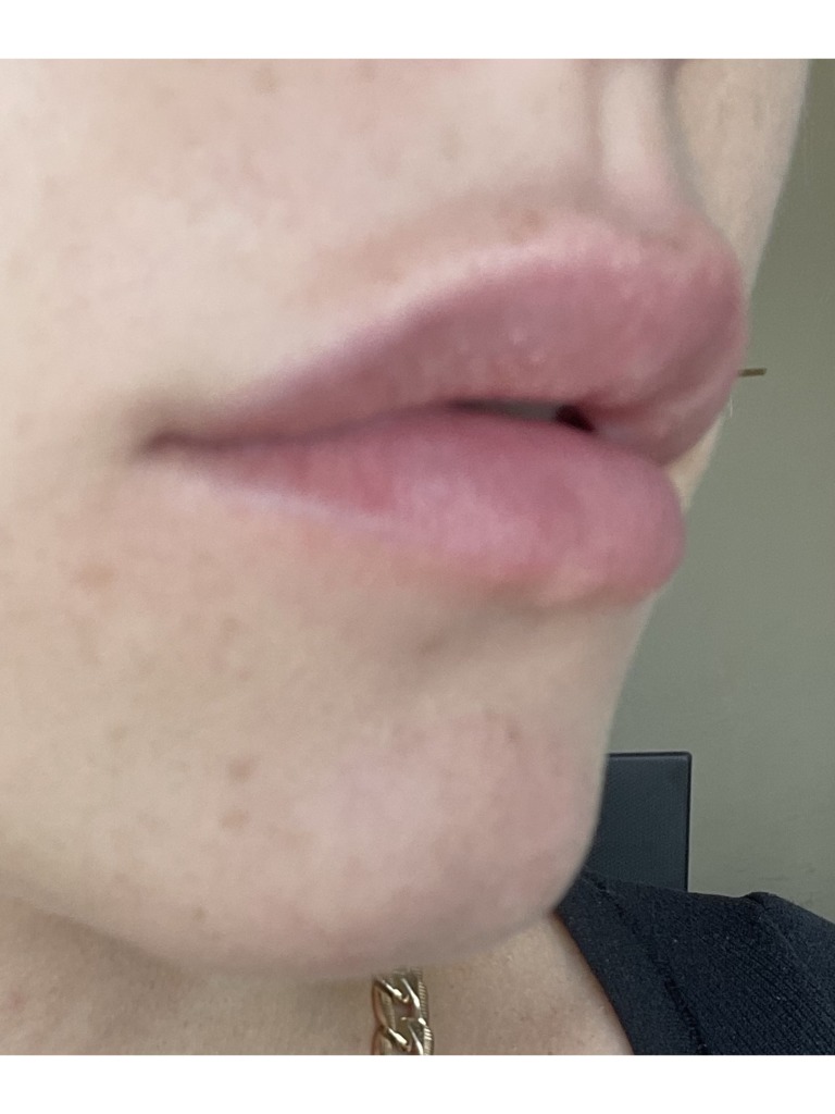 Фото 2. Уплотнение на губе после коррекции