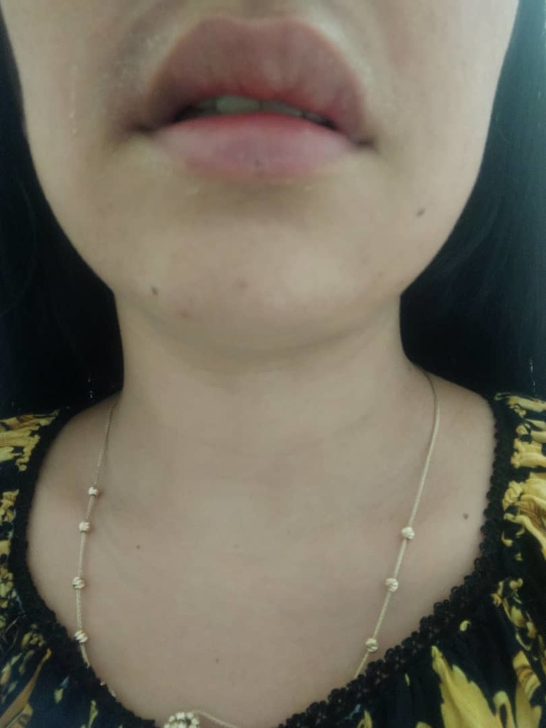 Фото 1. Отек после коррекции филлером