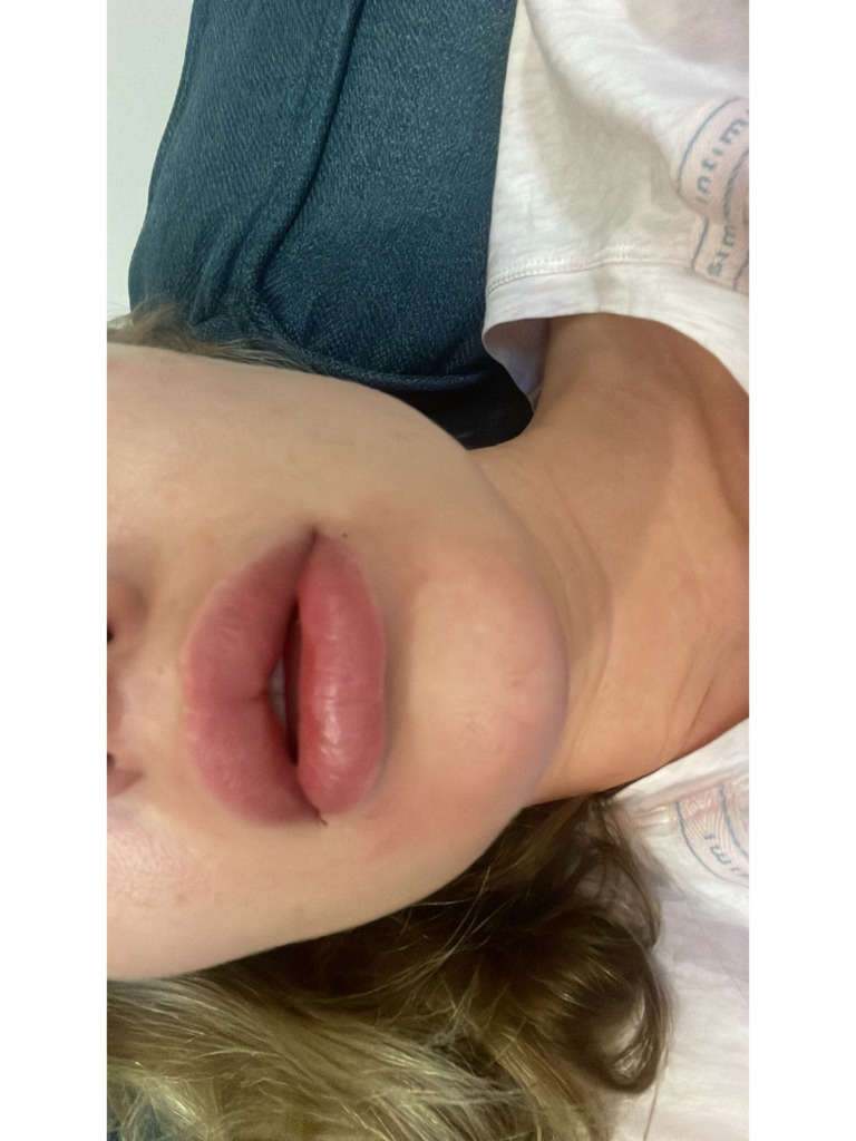 Фото 1. Миграция филлера