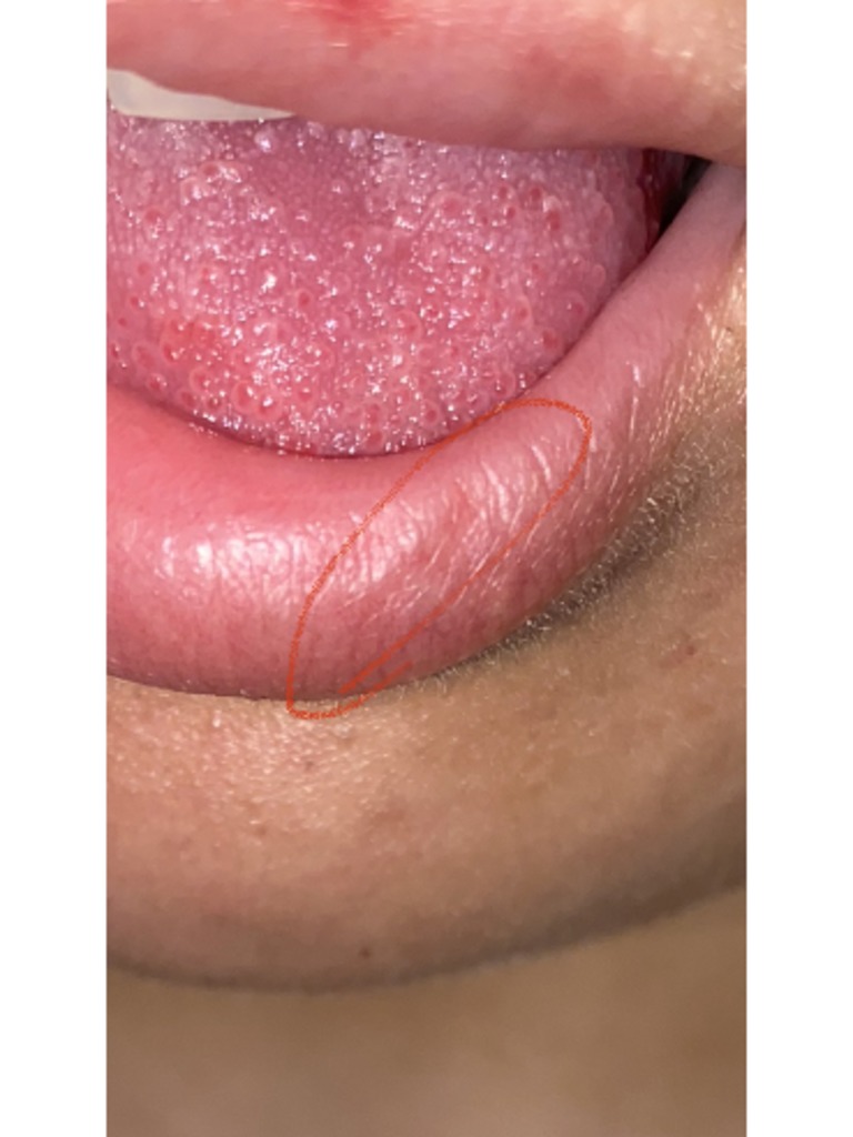 Фото 1. Осложнение после коррекции губ