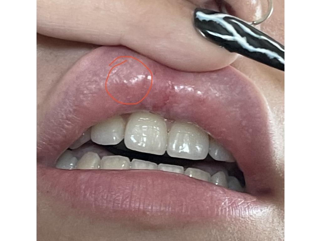 Фото 1. Уплотнение на губе после коррекции