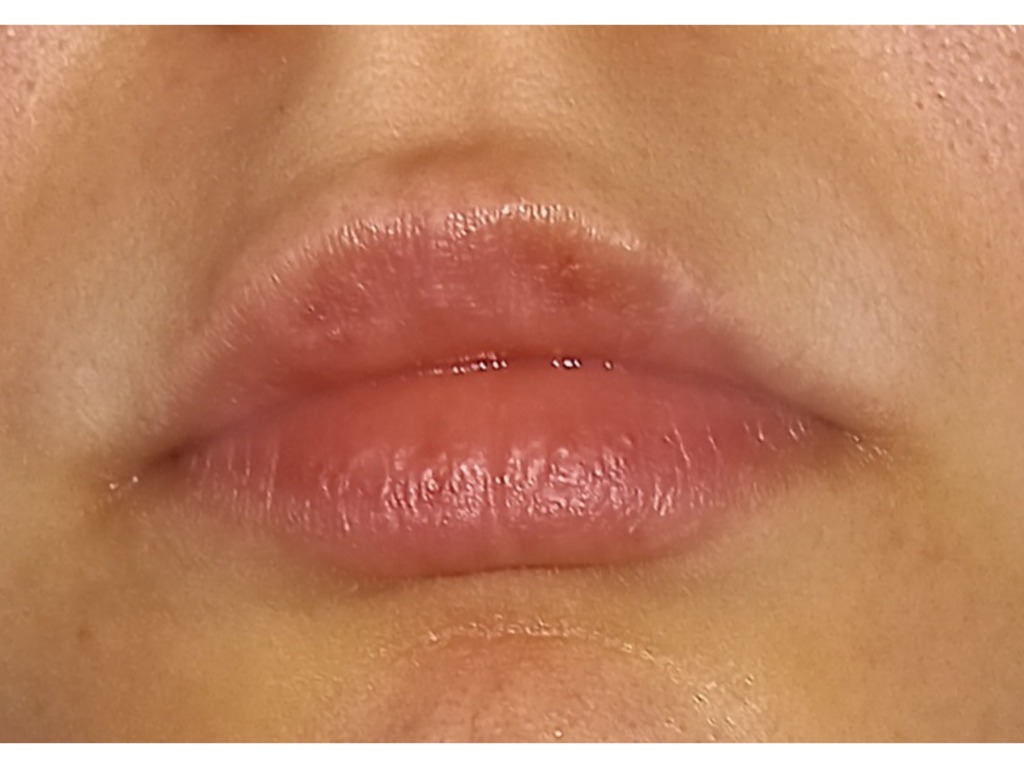 Фото 1. Миграция филлера