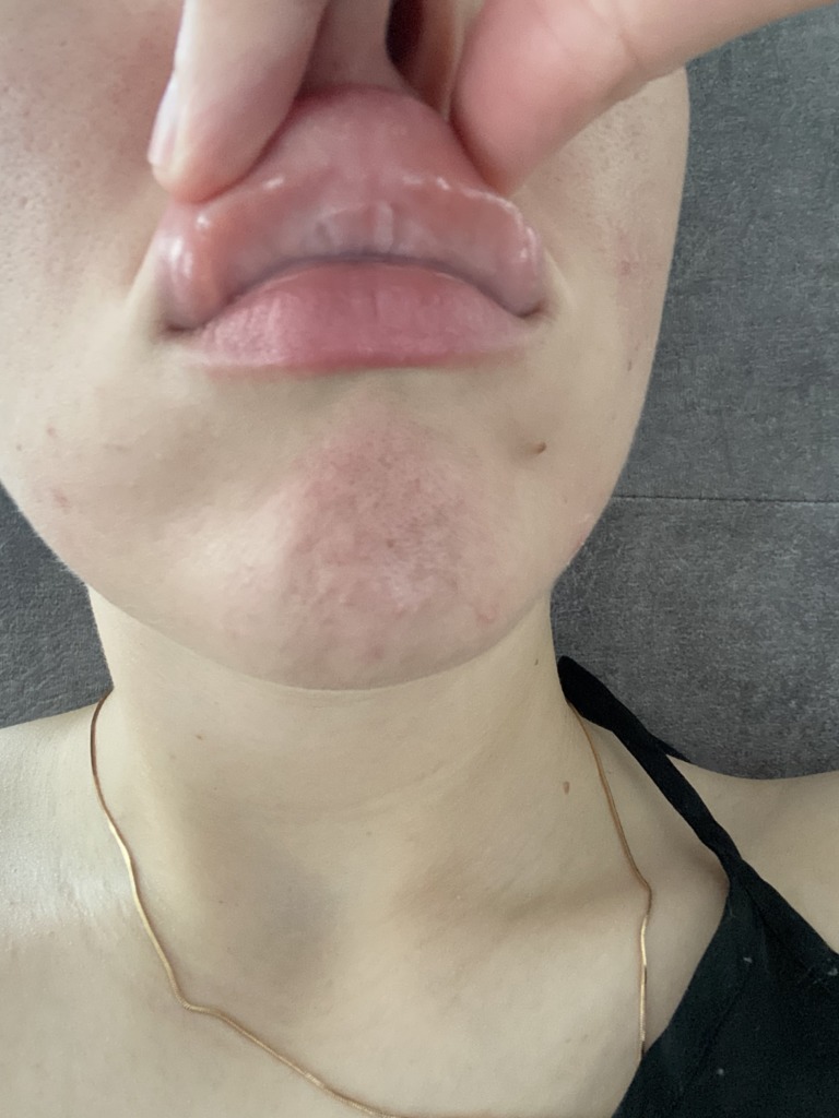 Фото 2. Миграция геля под верхнюю губу