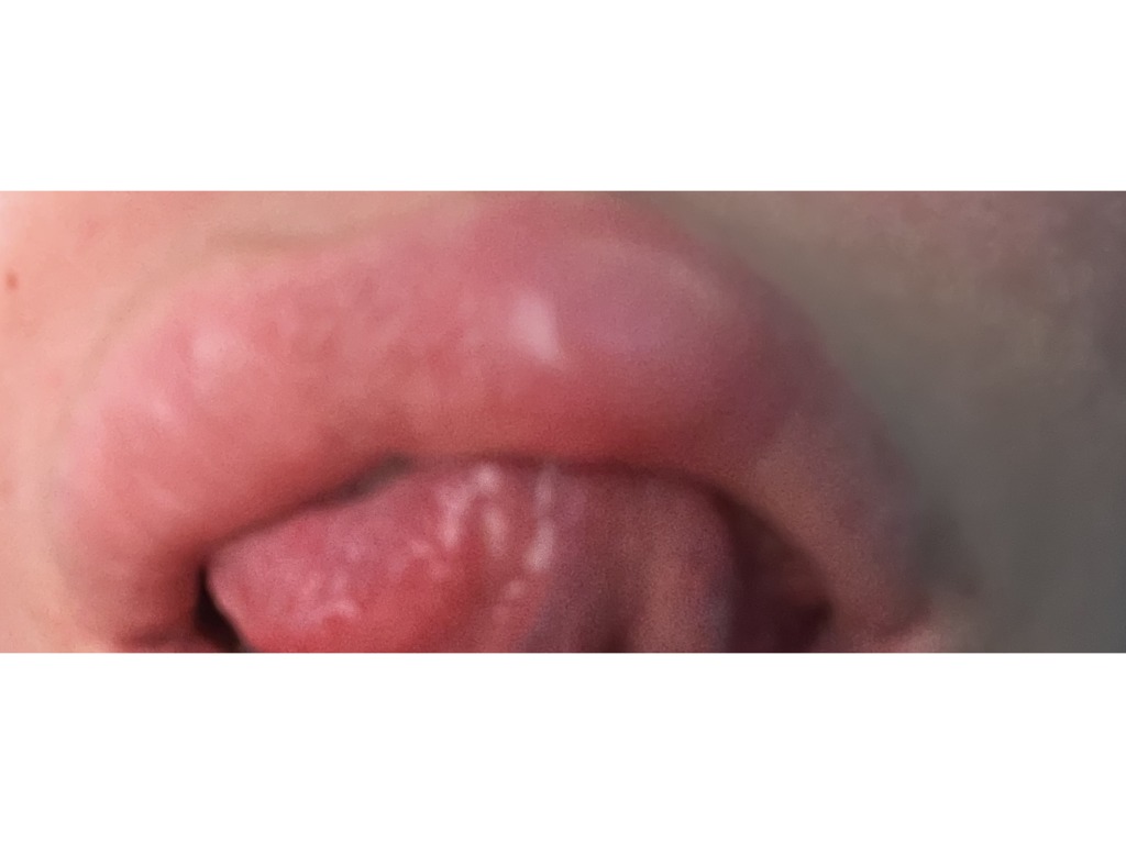 Фото 1. Уплотнения после коррекции губ