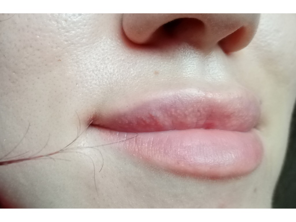 Фото 2. Уплотнение на верхней губе