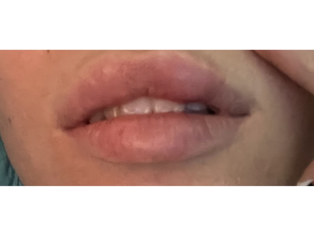 Фото 2. Уплотнения после коррекции губ