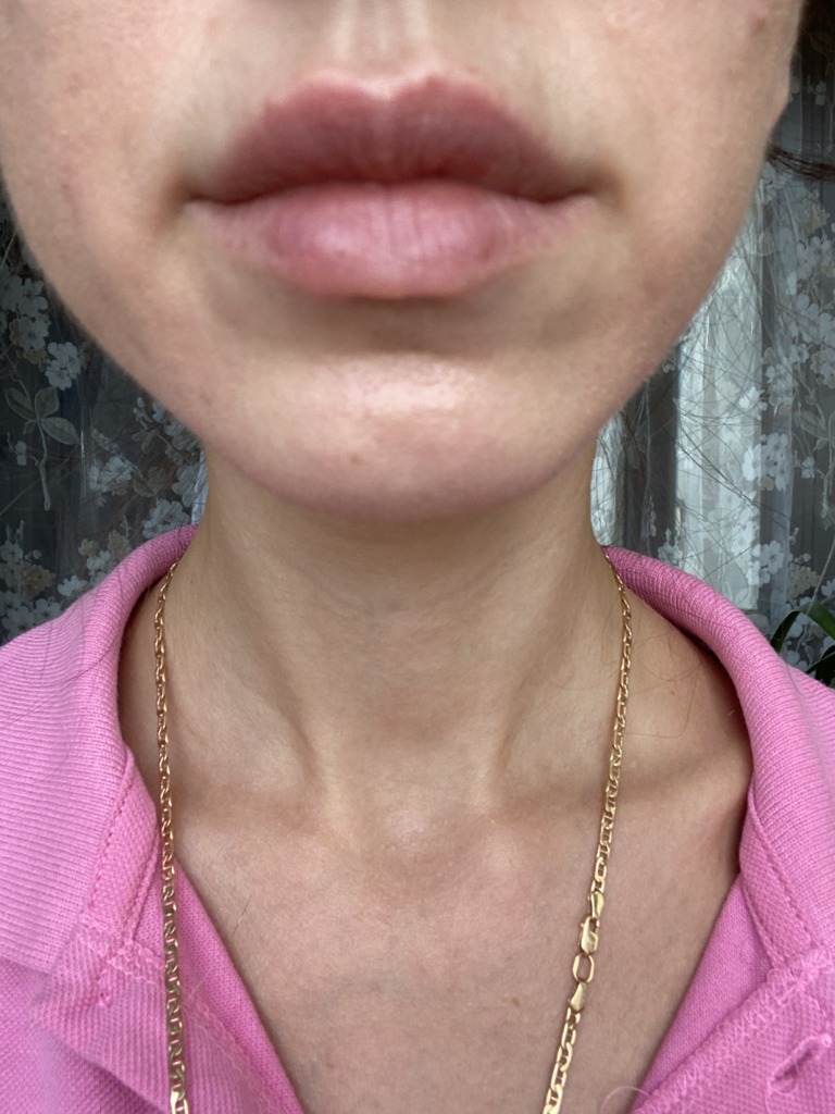 Фото 1. Уплотнения на губе после коррекции