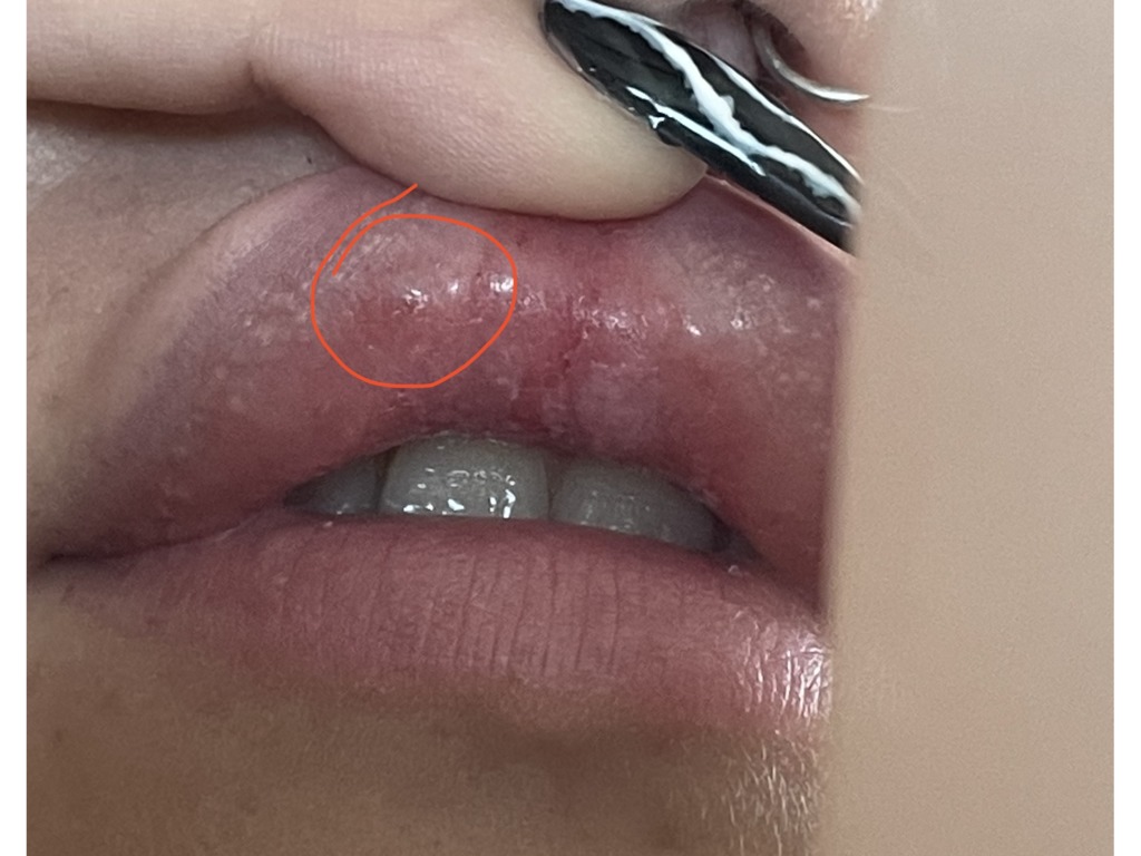 Фото 3. Уплотнение на губе после коррекции
