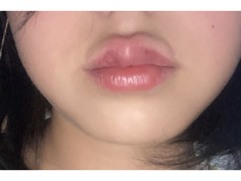 Фото 3. Отек после увеличения губ