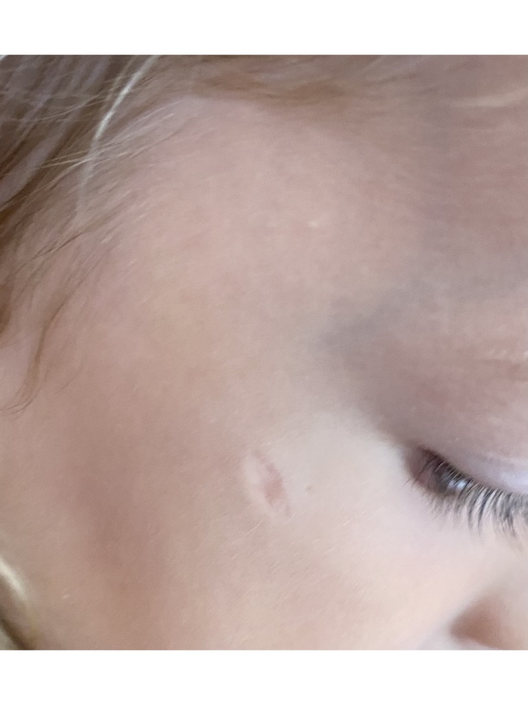 Фото 1. Лечение шрамов на лице у ребенка