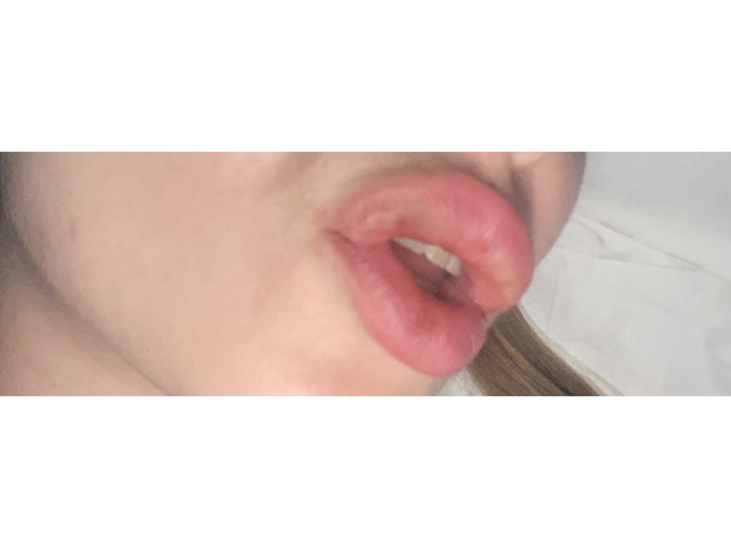 Фото 5. Осложнения после коррекции губ