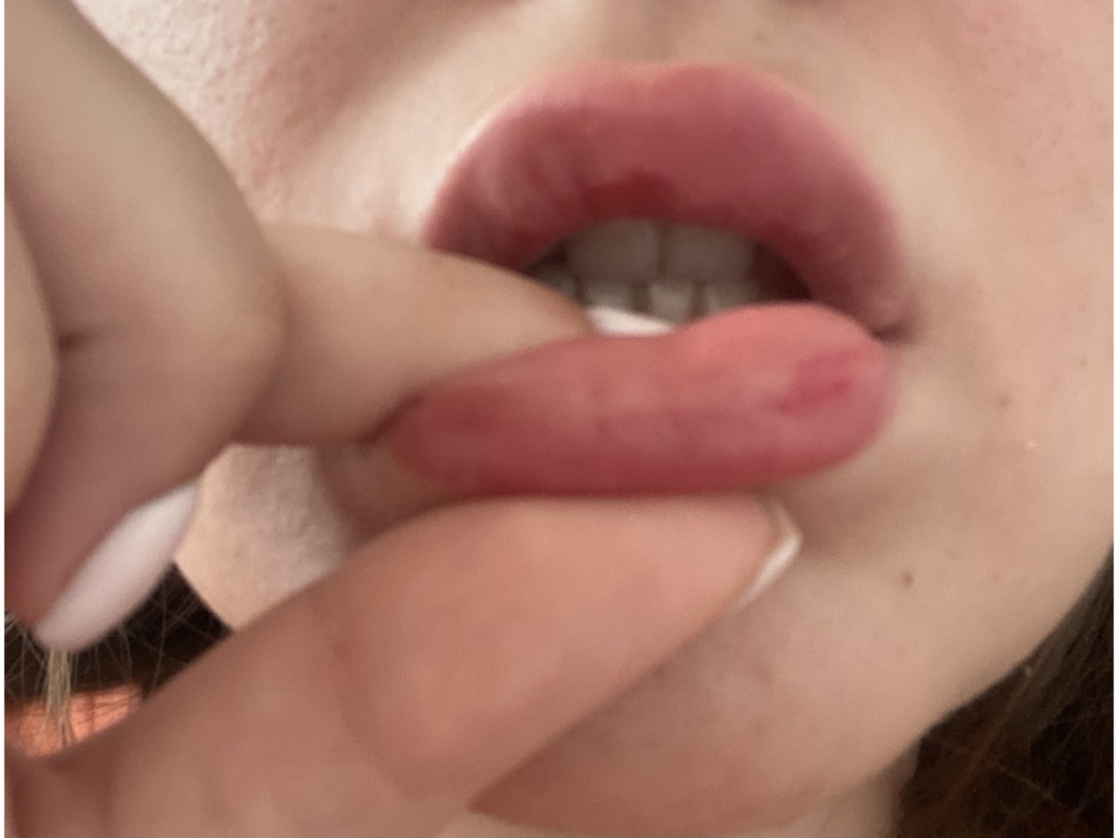 Фото 3. Контурная пластика губ
