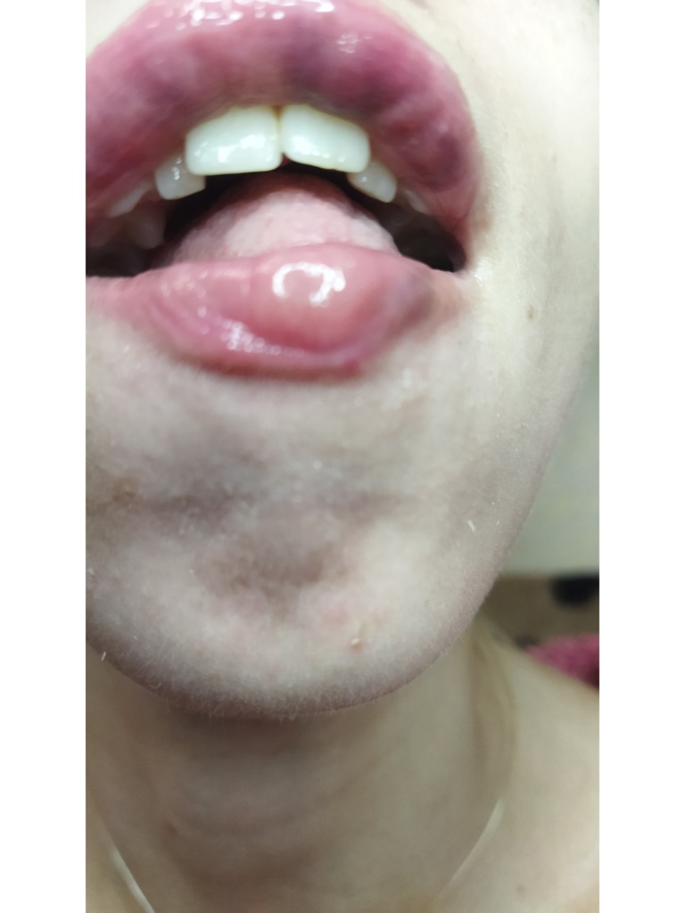 Фото 1. Осложнение после коррекции губ