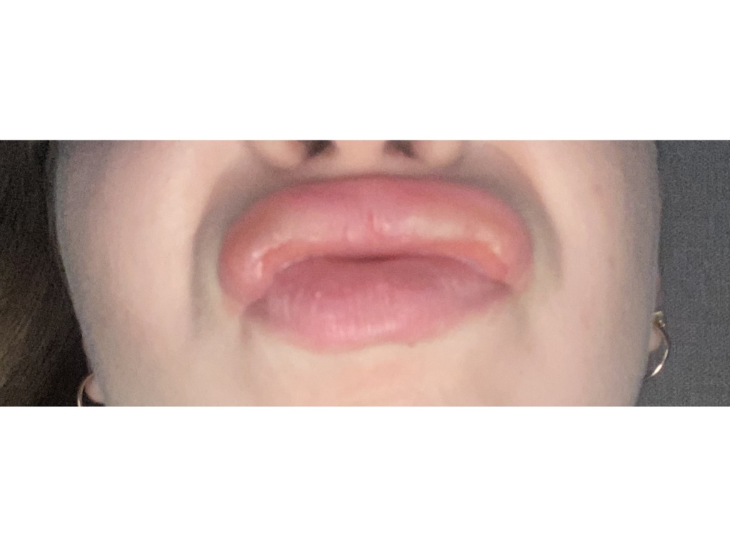 Фото 4. Осложнения после коррекции губ