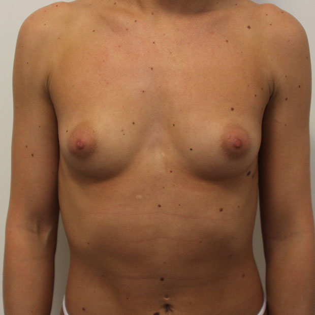 Увеличение груди жиром при помощи липосакции фото до операции