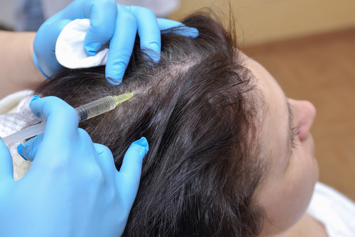 плазмолифтинг волосистой части головы